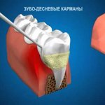 Мед.обработка пародонтальных карманов и межзубной борозды 1 зуба
